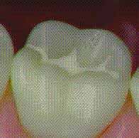Link to the Dental Sealant Program